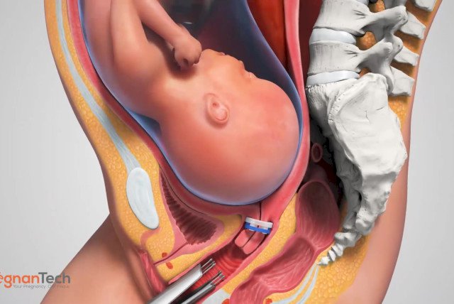 Baby born with 'twin' foetus inside her stomach
