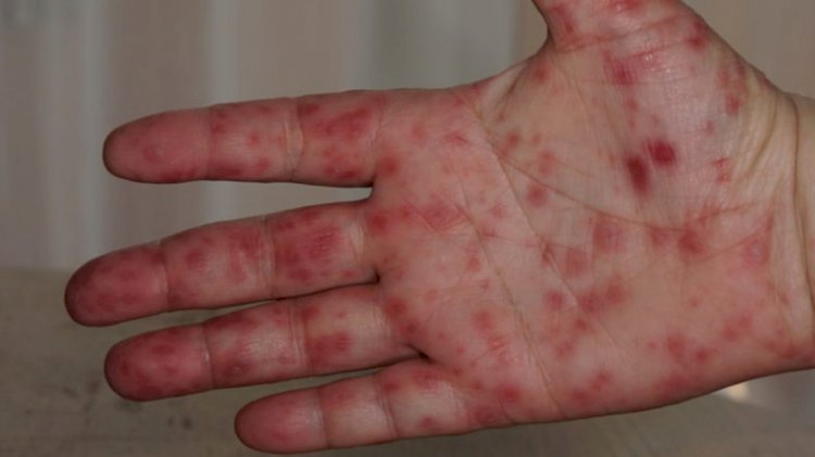 TN steps up vigil as tomato fever spreads
