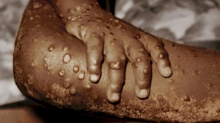 ‘Urgency’: WHO expects more monkeypox cases globally